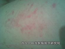 银屑病症状 银屑病症状