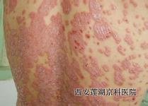 牛皮癣的诊断方法有哪些 牛皮癣的诊断方法有哪些